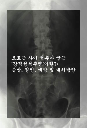  모르는 사이 척추가 굳는 '강직성척추염'이란?: 증상, 원인, 예방 및 대처방안