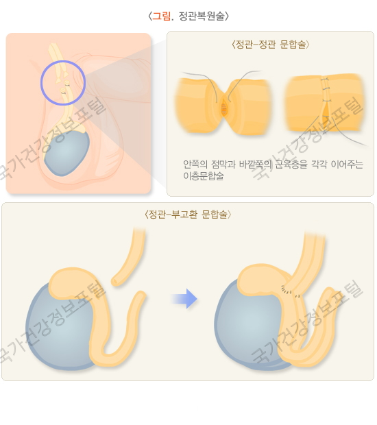 정관 복원술