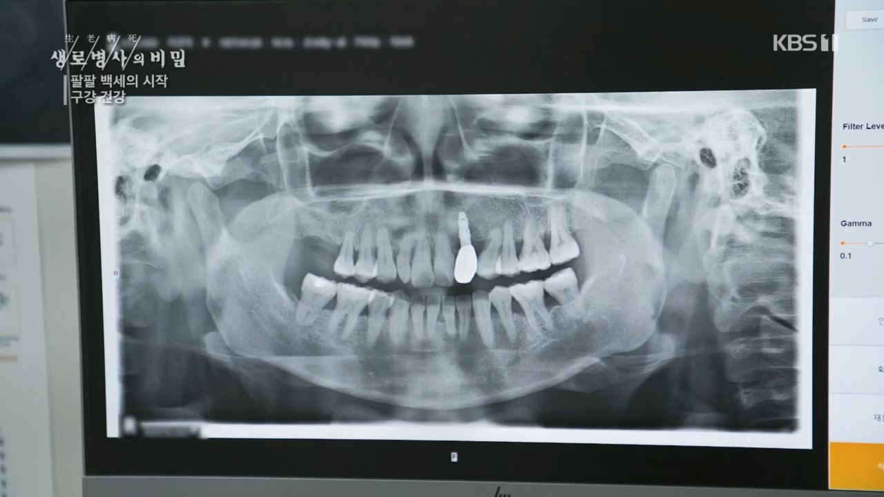 생로병사의 비밀.E894.240118p.H264-F1RST.mp4_20240118_195352.111.jpg