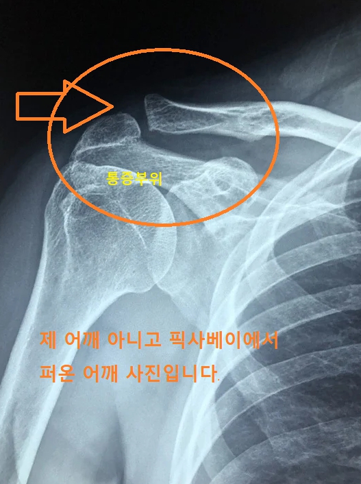 어깨 통증 관련 경험담
