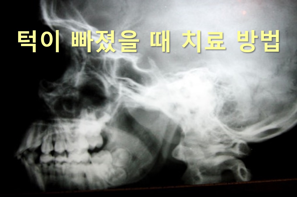  턱이 빠졌을 때 치료 방법과 턱이 빠지는 이유