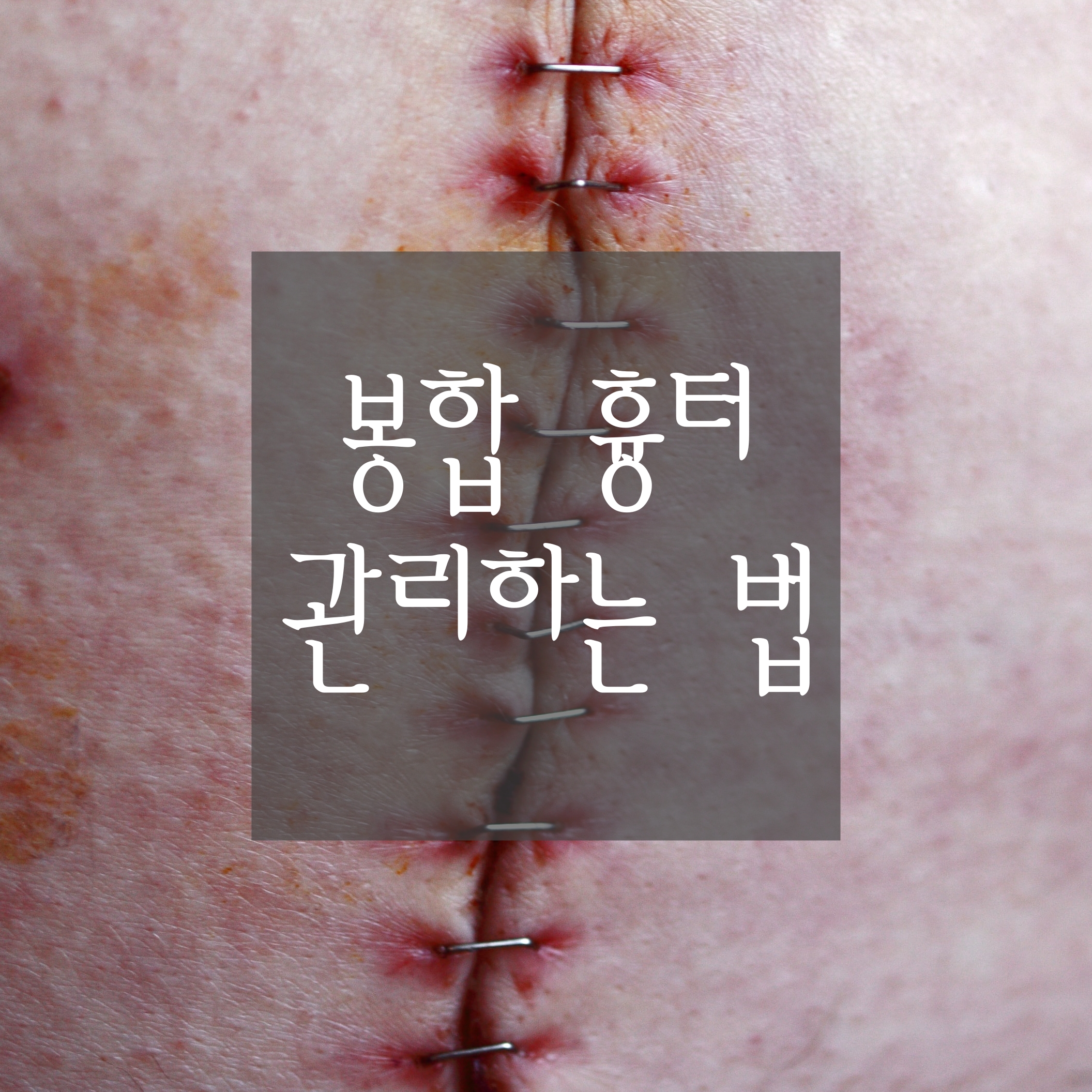  [봉합수술 흉터 관리] 흉터 최소화하기! 흉터관리 효과적으로 하는 법(스테리-스트립, 스키니쿠스, 렘스카켈)