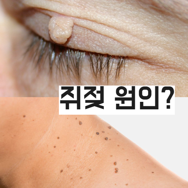  얼굴에 뭐가 났어요 쥐젖 어떻게 관리 하는가?
