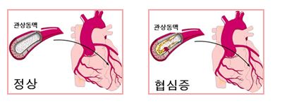 협심증 증상