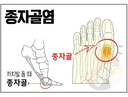 종자골염은-엄지발가락-아래에-있는-씨앗-모양의-뼈에-의해-발생한-염증입니다.