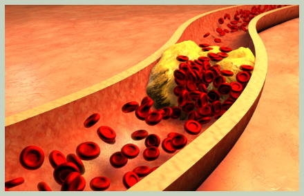 콜레스테롤 막힘 현상