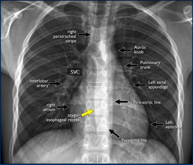 정상성인흉부 CHEST PA