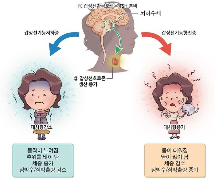 갑상선 사진