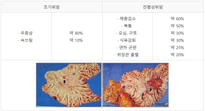 위암 표