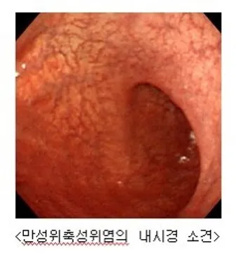 위염초기증상 역류성 식도염 차이점_17