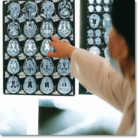 뇌경색 원인 및 전조증상&#44; CT 영상