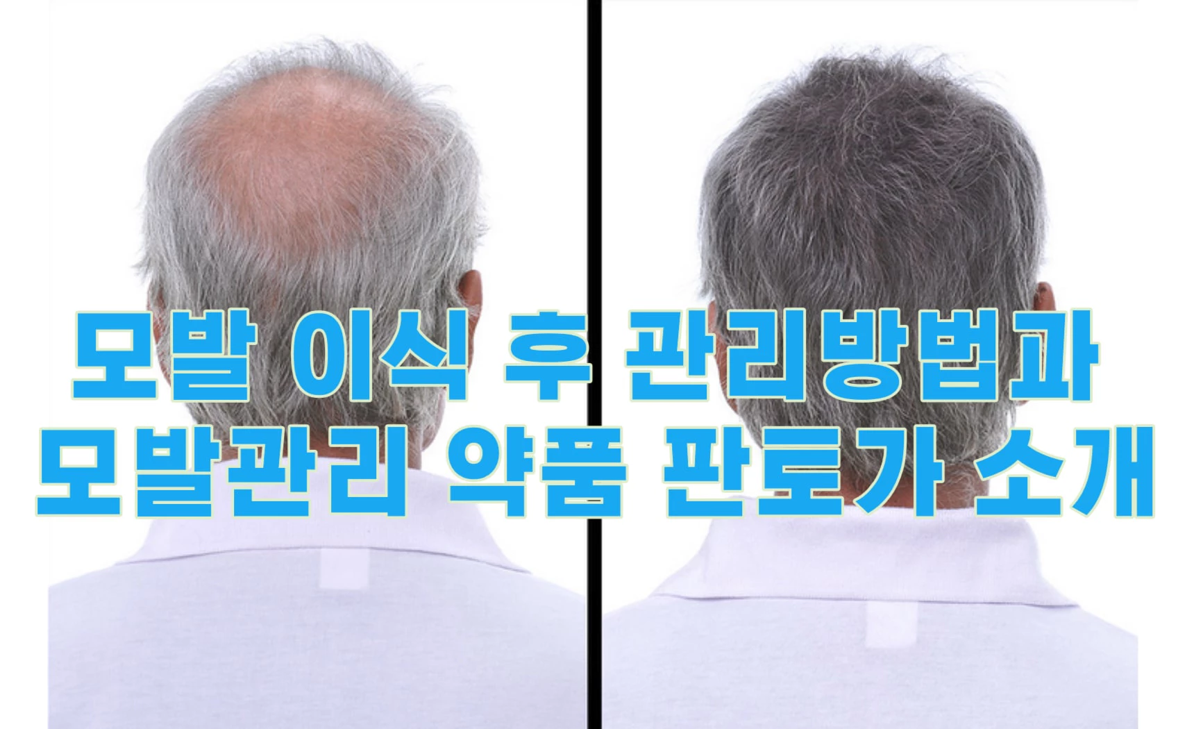 모발 이식 후 관리방법과 모발관리 약품 판토가 소개