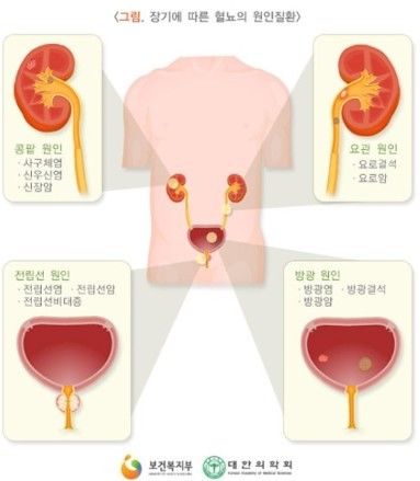 요로결석 증상