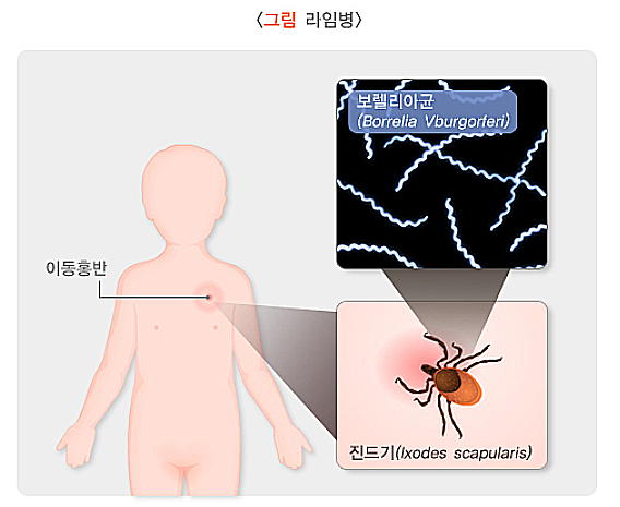 라임병 국내 감염자 증가