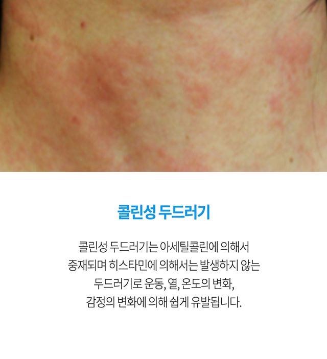 콜린성 두드러기