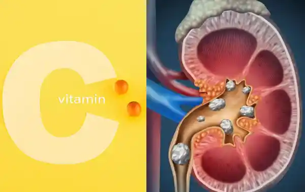 비타민C 과다복용 증상&#44; 신장결석