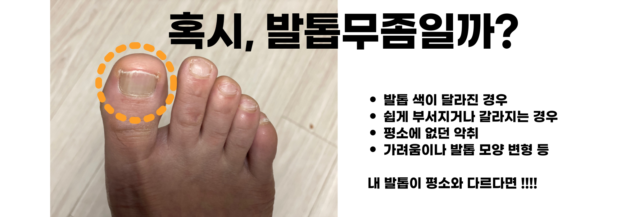 발톱 무좀 치료