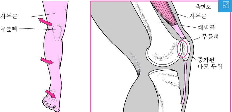 무릎통증-앞무릎-원인-관절염