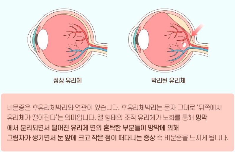 비문증이 발생하는 원인중 가장 큰 유리체박리(망막에서 떨어지는 현상)