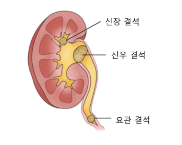 극심한 고통! 요로결석이란? 원인·초기증상·통증·수술·예방·여성 요로결석까지 완전정리