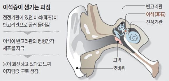 이석증 증상