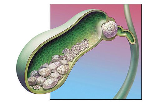 담낭 결석 증상