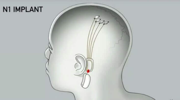 머스크-인간-뇌에-칩-이식
