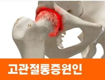 고관절 통증 증상 확인하기_22