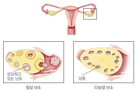  난임부부 최대의 적! 다낭성 난소 증후군! 지금부터 그 실체를 파헤쳐보자!