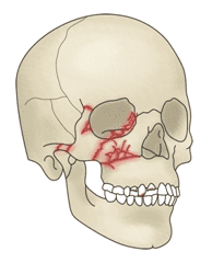 안와 골절 형태