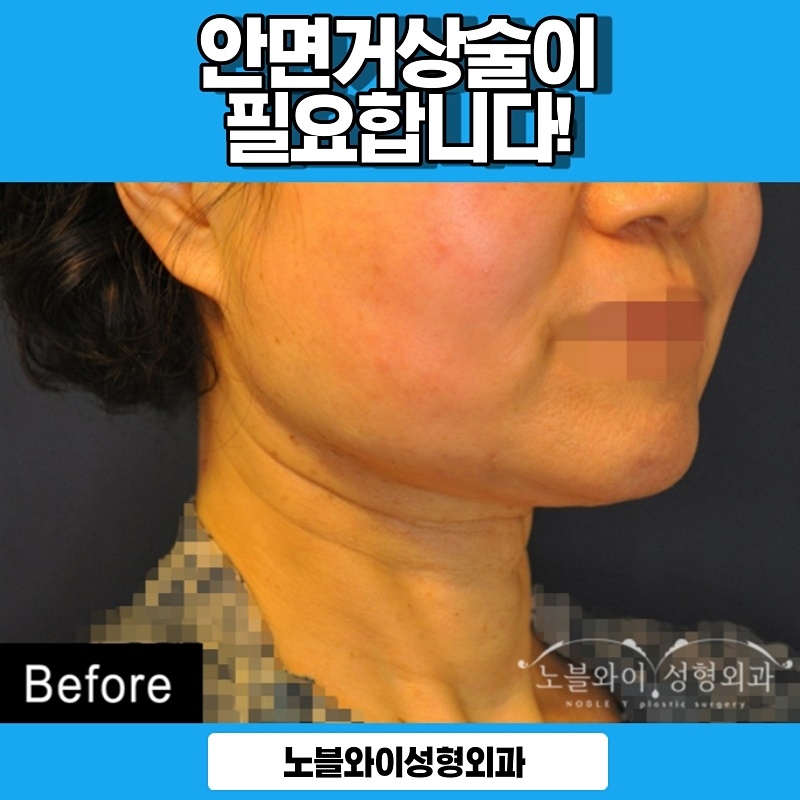  안면거상수술비용 후회안남을 효과 모습
