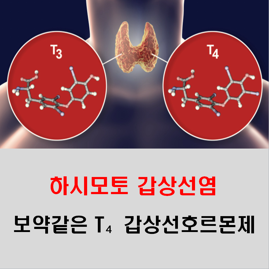  하시모토 갑상선염이 있을 때 보약같은 갑상선호르몬제