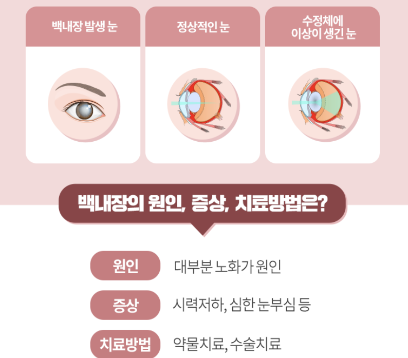 백내장 증상 12가지 총정리 섬네일