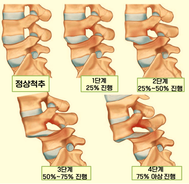 척추 전방 전위증 진행단계