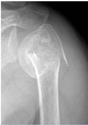 근위 상완공 골절 사진 출처 대한 정형외과 학회 홈페이지