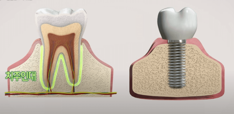 임플란트 주위염 ; 증상&amp;#44; 원인&amp;#44; 예방 및 관리방법 알아보기(재수술&amp;#44; 부작용&amp;#44; 재식립)