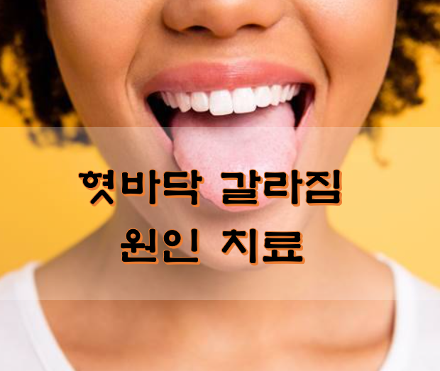  혓바닥 갈라짐 원인 치료