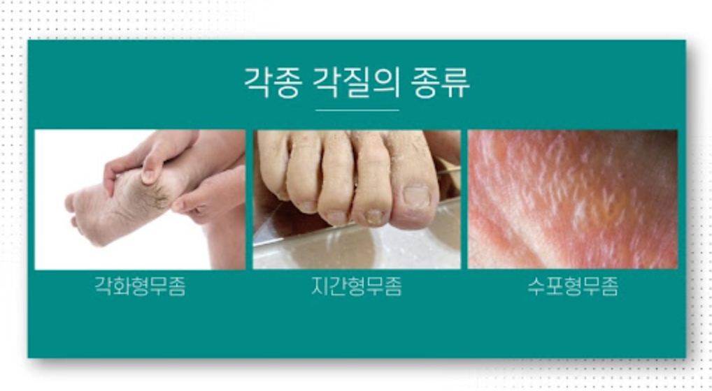 발바닥 피부 벗겨짐