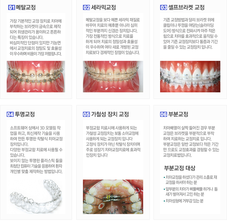 치아교정장치방법및종류