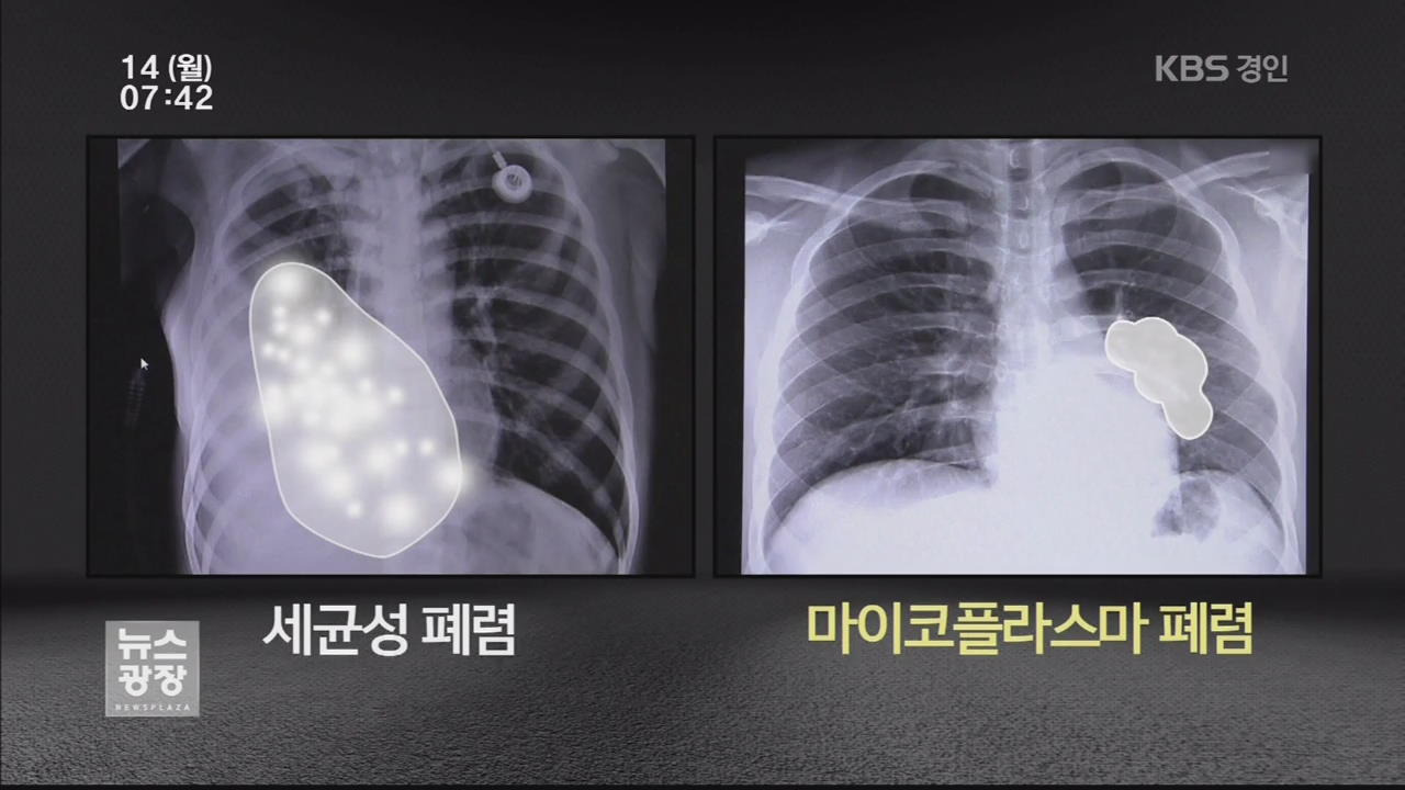 마이코플라즈마 폐렴