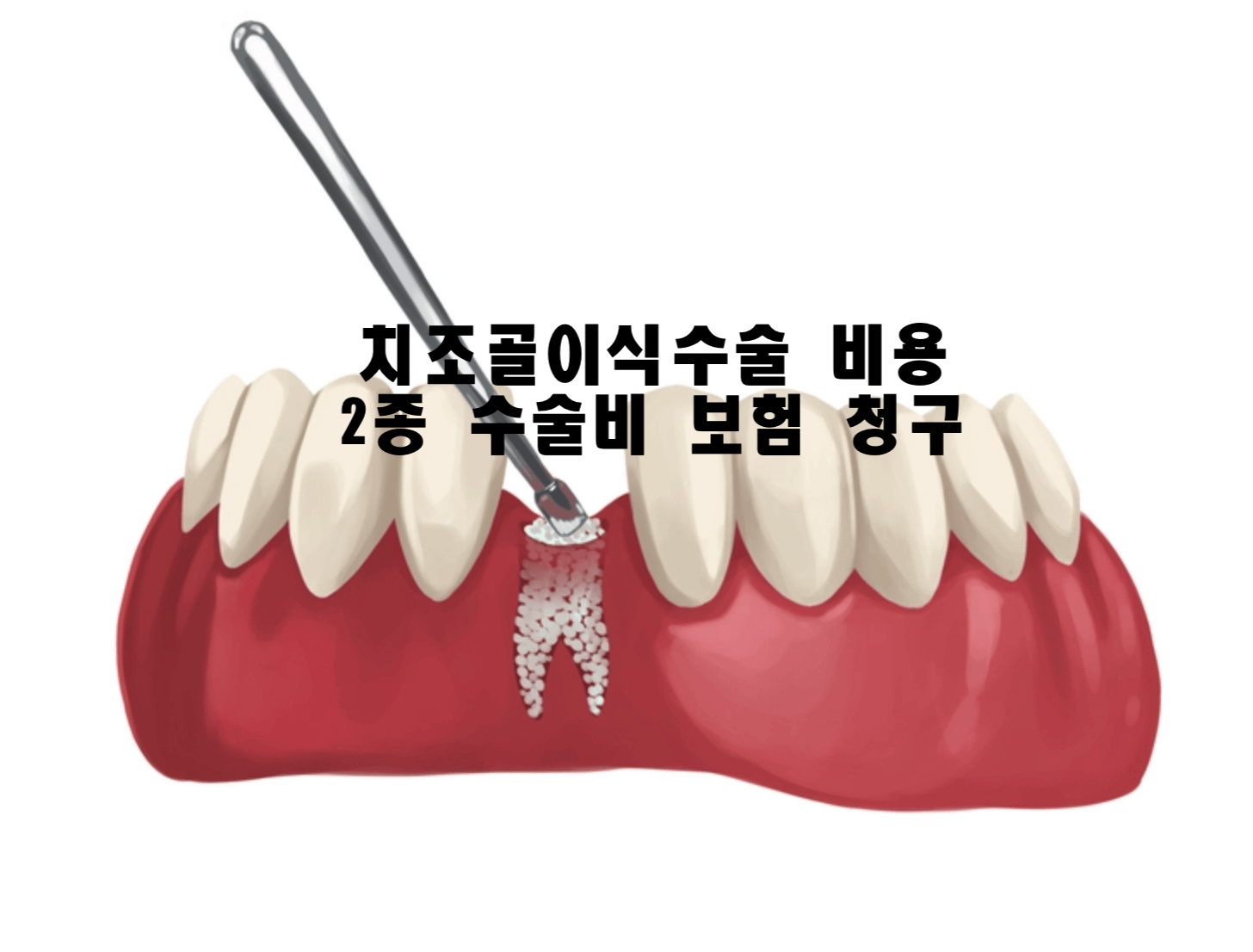 치조골이식 수술비용