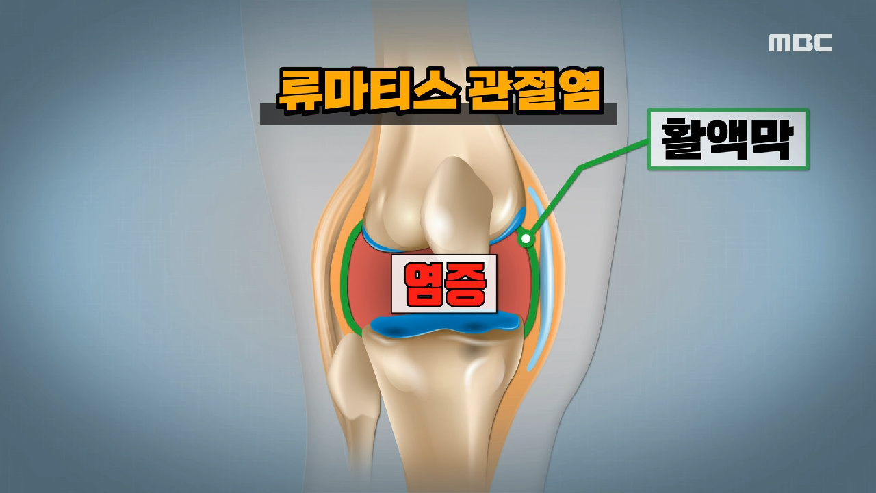  기분 좋은날 다이어트 주범 뱃살 만성 염증 원인 증상 치료 예방 질환 염증 제거 대마종자유 효능 효과 지방 세포 다이어트 꿀팁 복부 지방 사방팔방스텝운동법 만성 염증 자가 진단 테스트