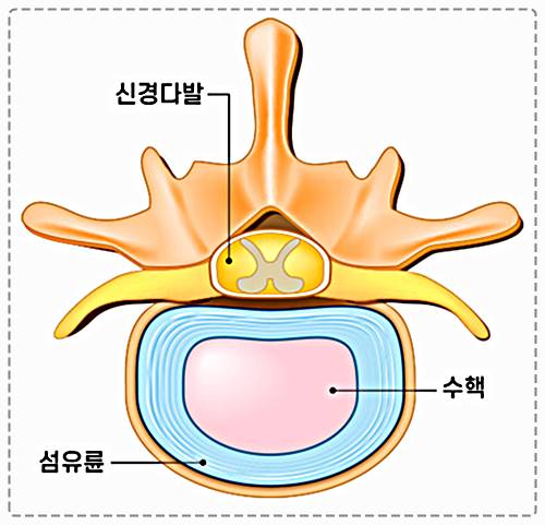 허리디스크1