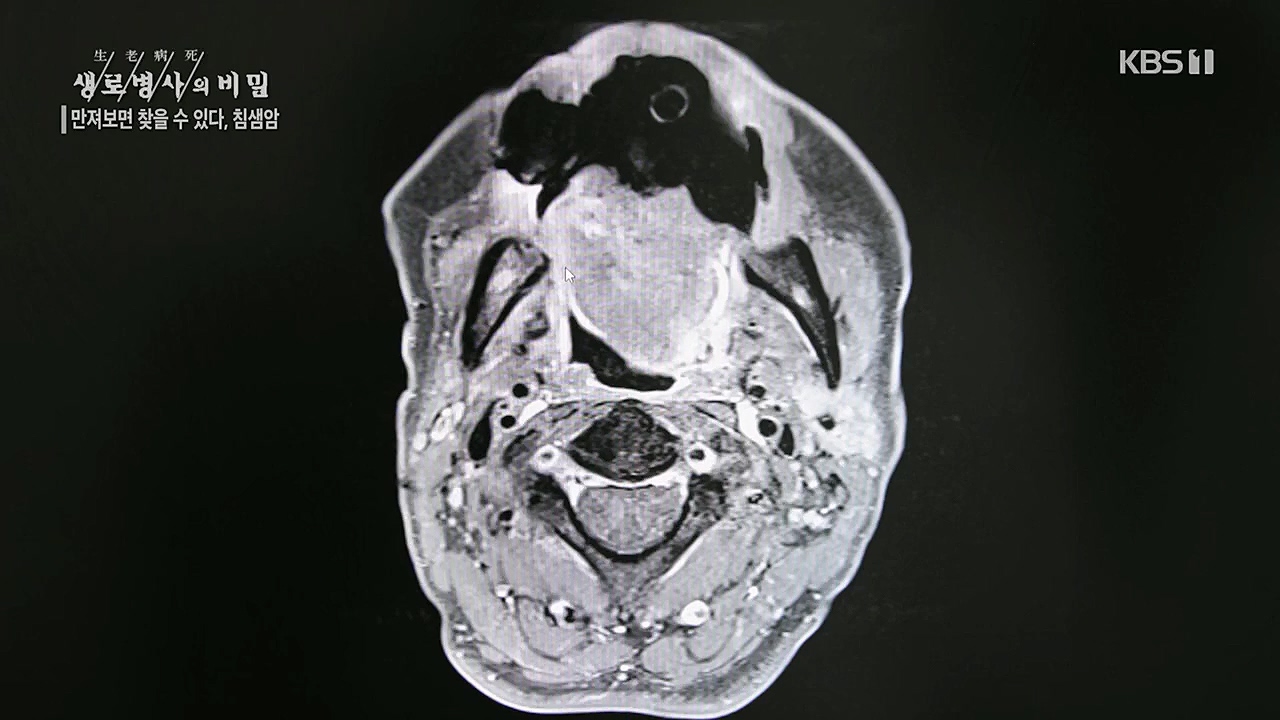 생로병사의 비밀.E851.230112p.H264-F1RST.mp4_20230119_200623.612.jpg