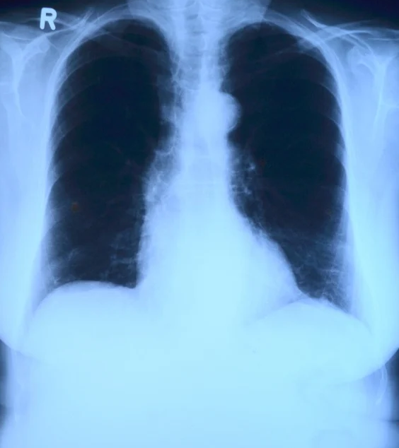 이 사진은 폐의 사진입니다