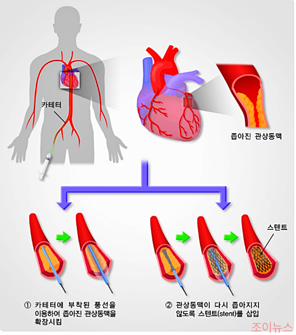 경피적 관상동맥 중재술(PCI)_출처:국가건강정보포털