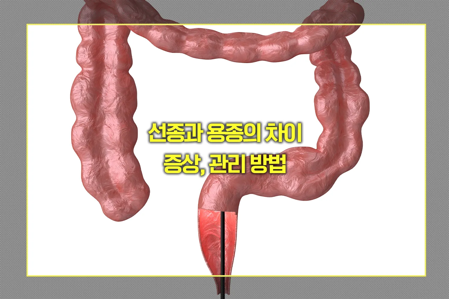 선종과 용종의 차이 및 증상, 관리 방법