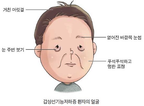 갑상선 기능 저하증 완치하는 법