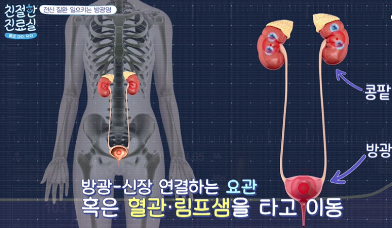 여성방광염 원인 및 증상 치료방법