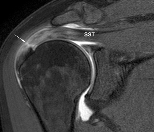 어깨-MRI-사진